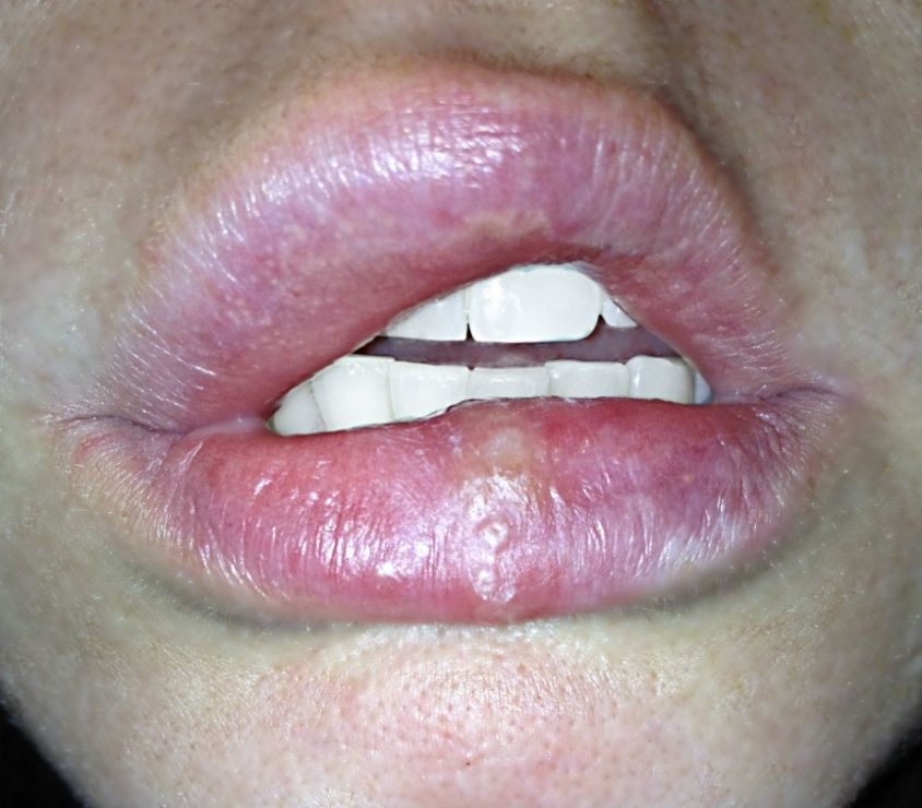 oral herpes pictures on throat