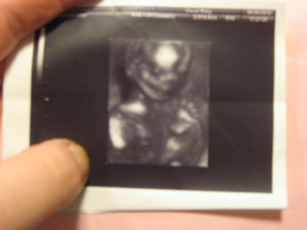 Baby's nose at 20 week ultrasound BabyCenter